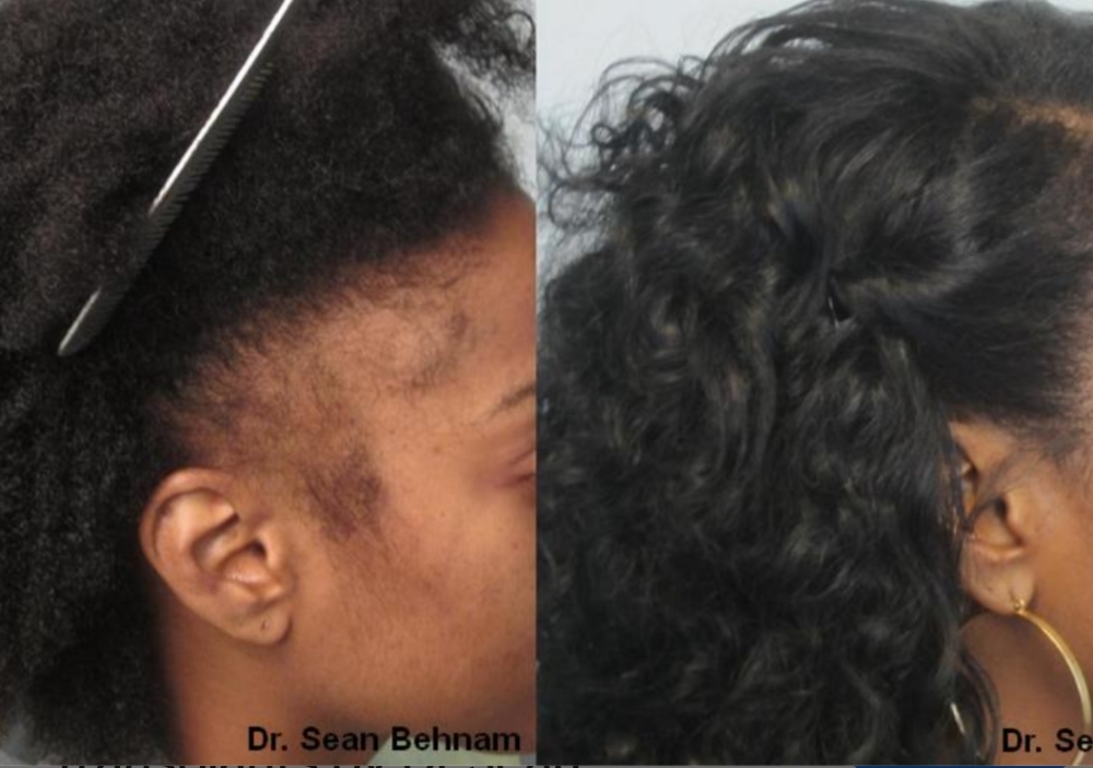 Coming Soon:Hair Thinning Treatment