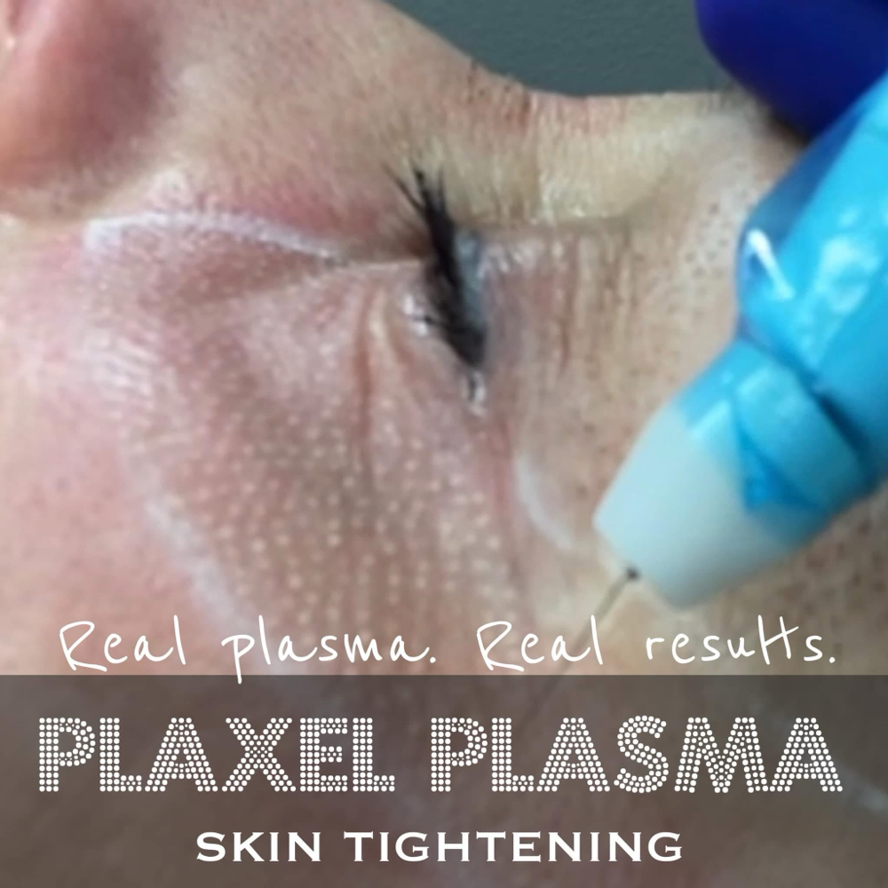 🌟PLASMA FIBROBLAST CONSULTATION