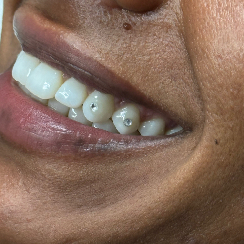 Additional Tooth Gem at Natalia’s Esthetics in Grants Pass, OR