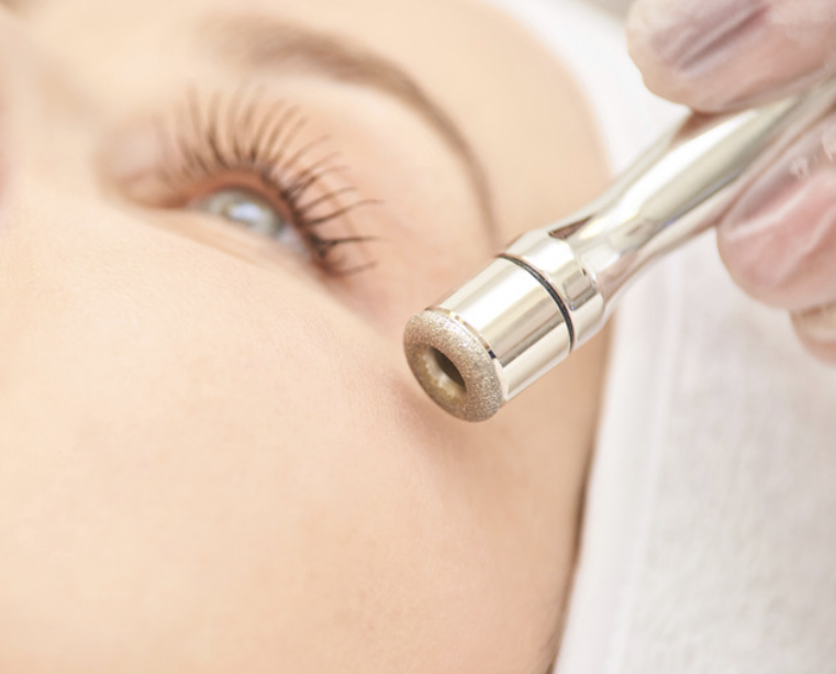 Microdermabrasion