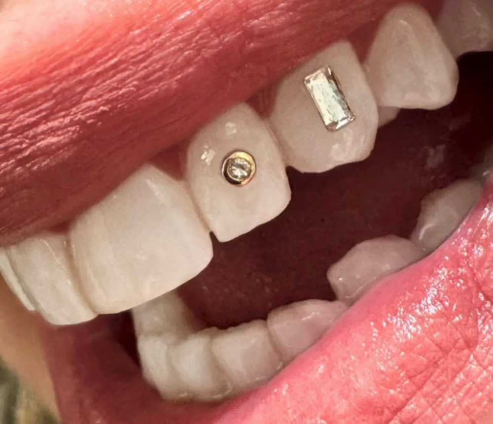 Tooth Gems at Fairywhite Teeth Whitening in Artesia, CA