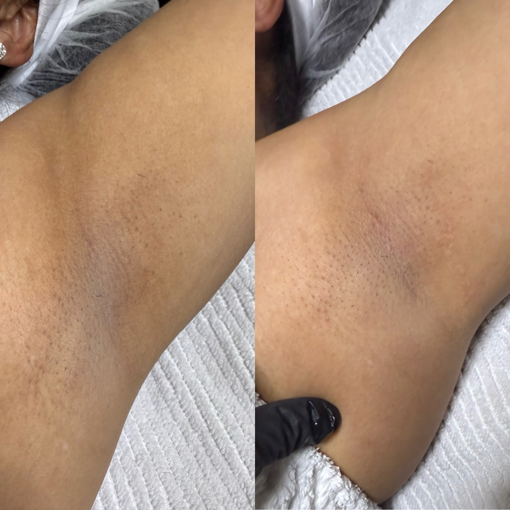 Skin Lightening treatment