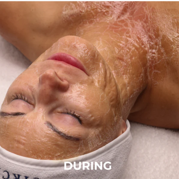 Needle-Free Lifting Facial at Pure Canvas Co. in San Jose, CA