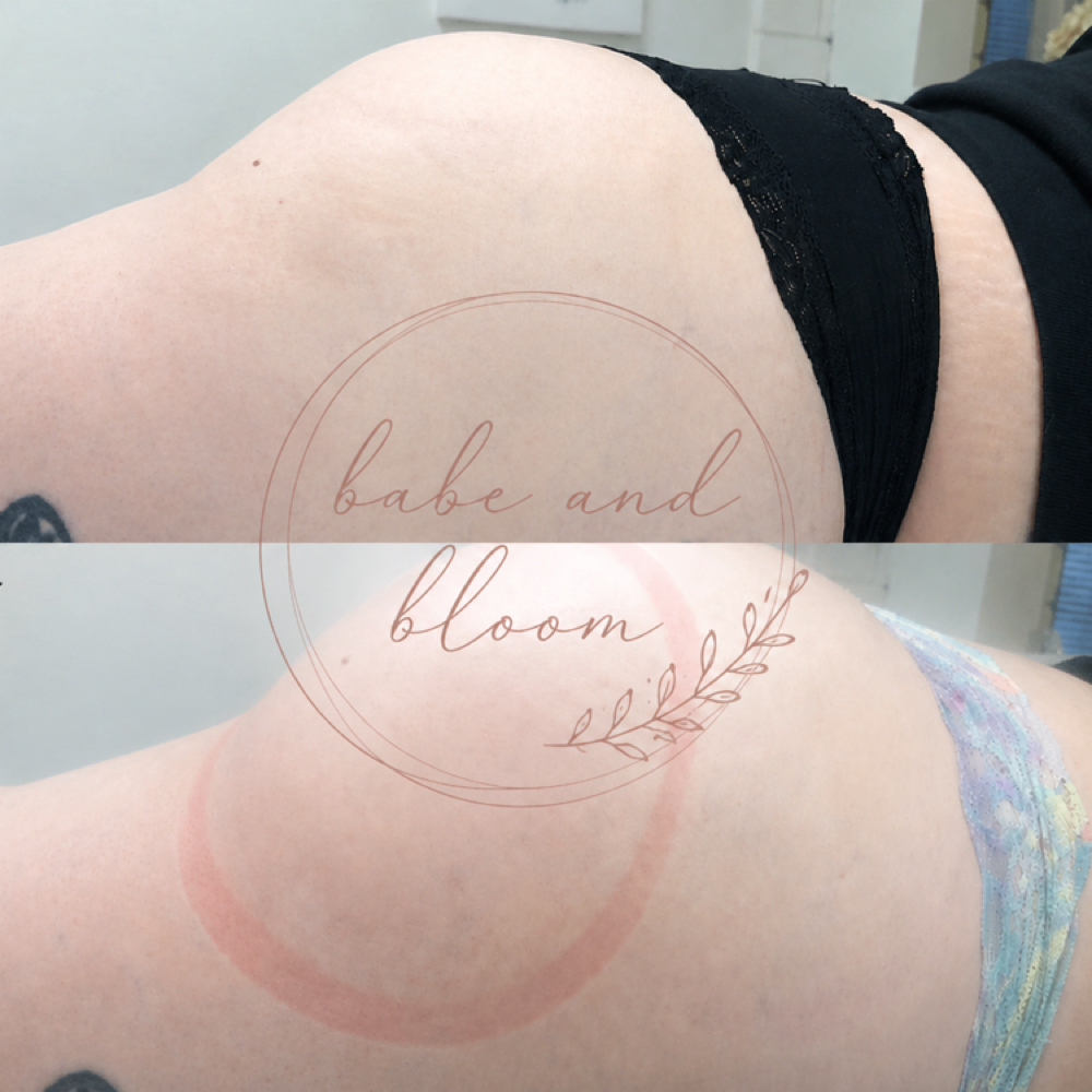 Butt Vacuum Therapy at Babe And Bloom in Prescott, AZ