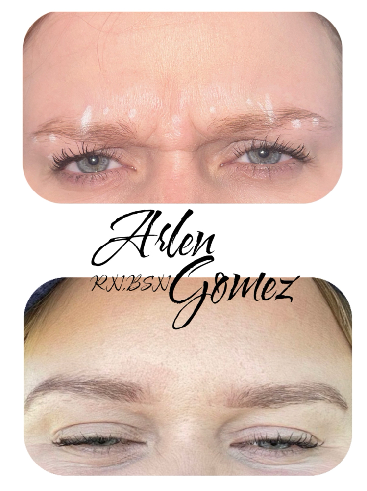 Glabella - 11’s -Xeomin