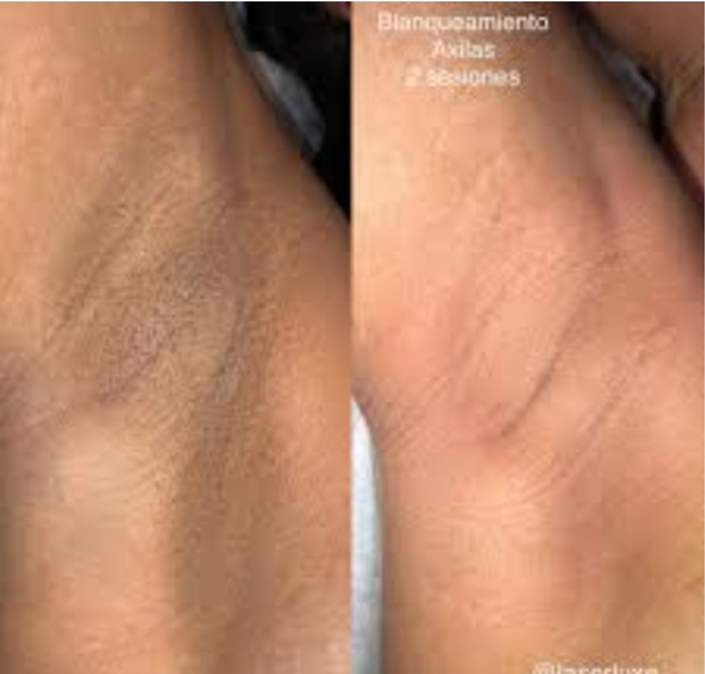 UNDERARM Whitening