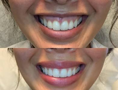 Lip Flip Treatment at Botox Injector Frisco in Frisco, TX