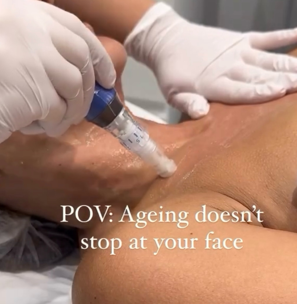 Exosome Microneedling Neck & Chest