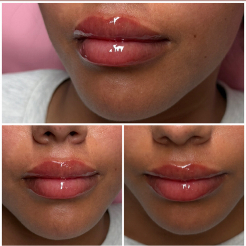 Mini Lip Refresh at Alt Boutique & Aesthetics | Nurse Injector in Hereford, TX
