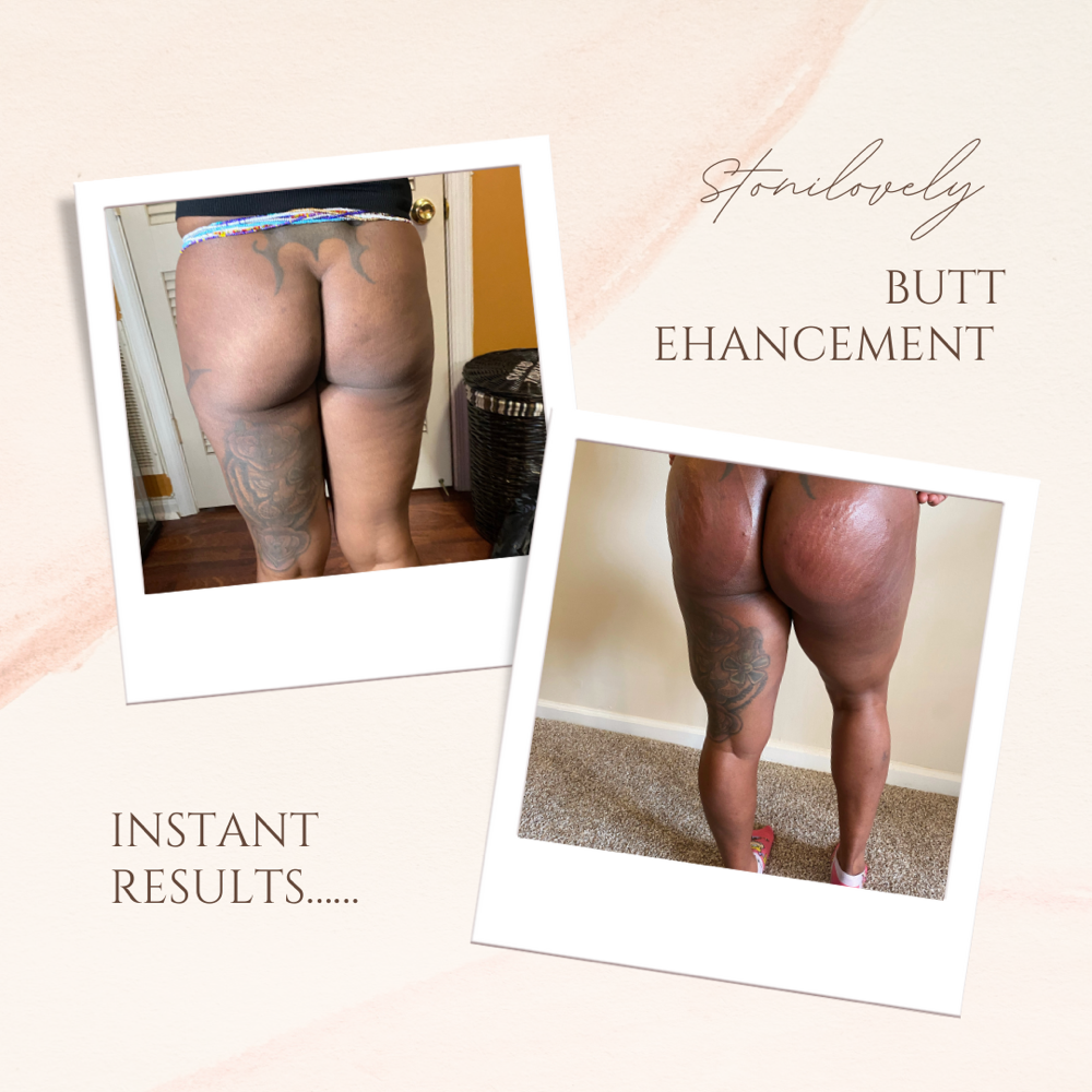 Non Invasive brazilian butt Lift