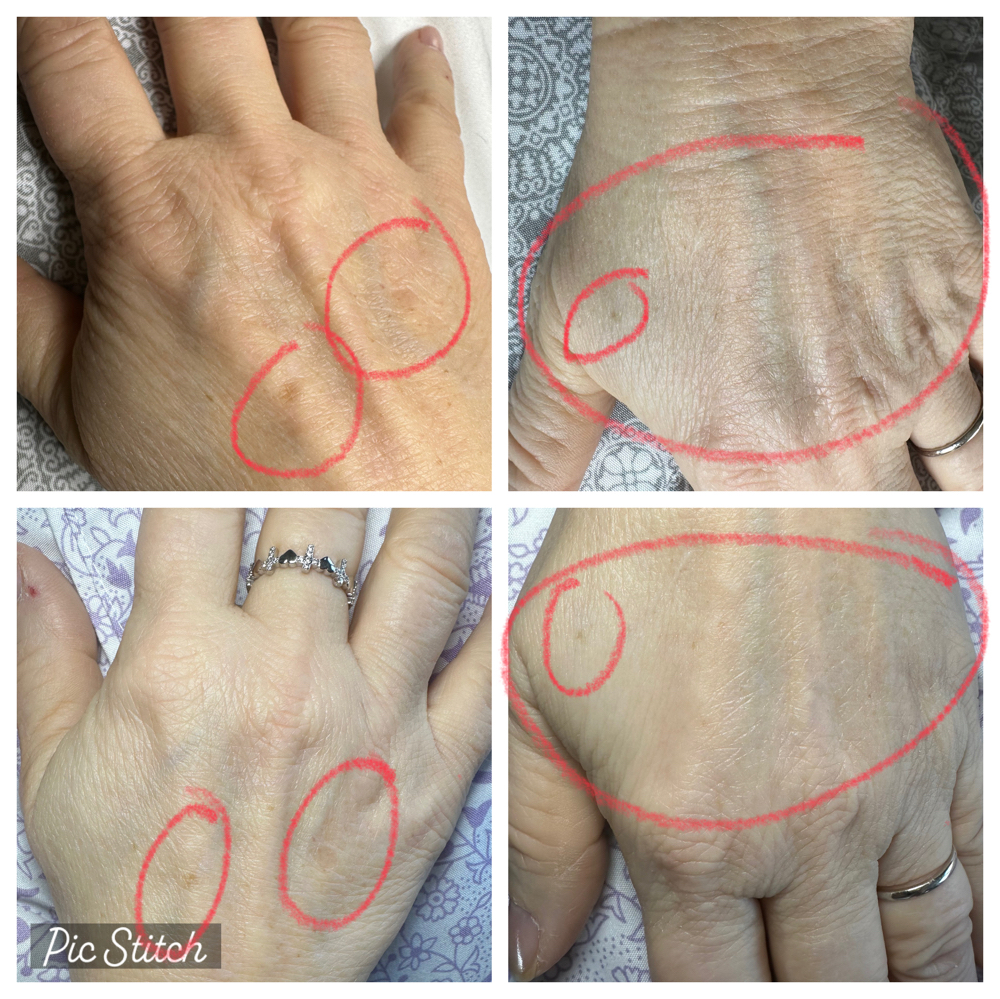 HANDS   Age/Sun Spots?