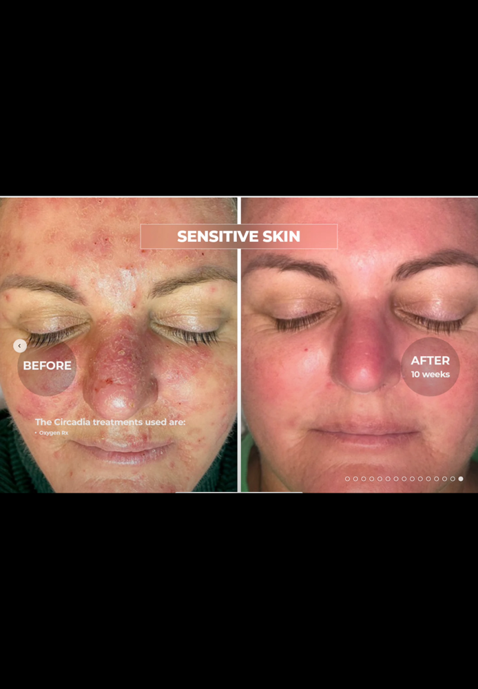 Oxygen Facial