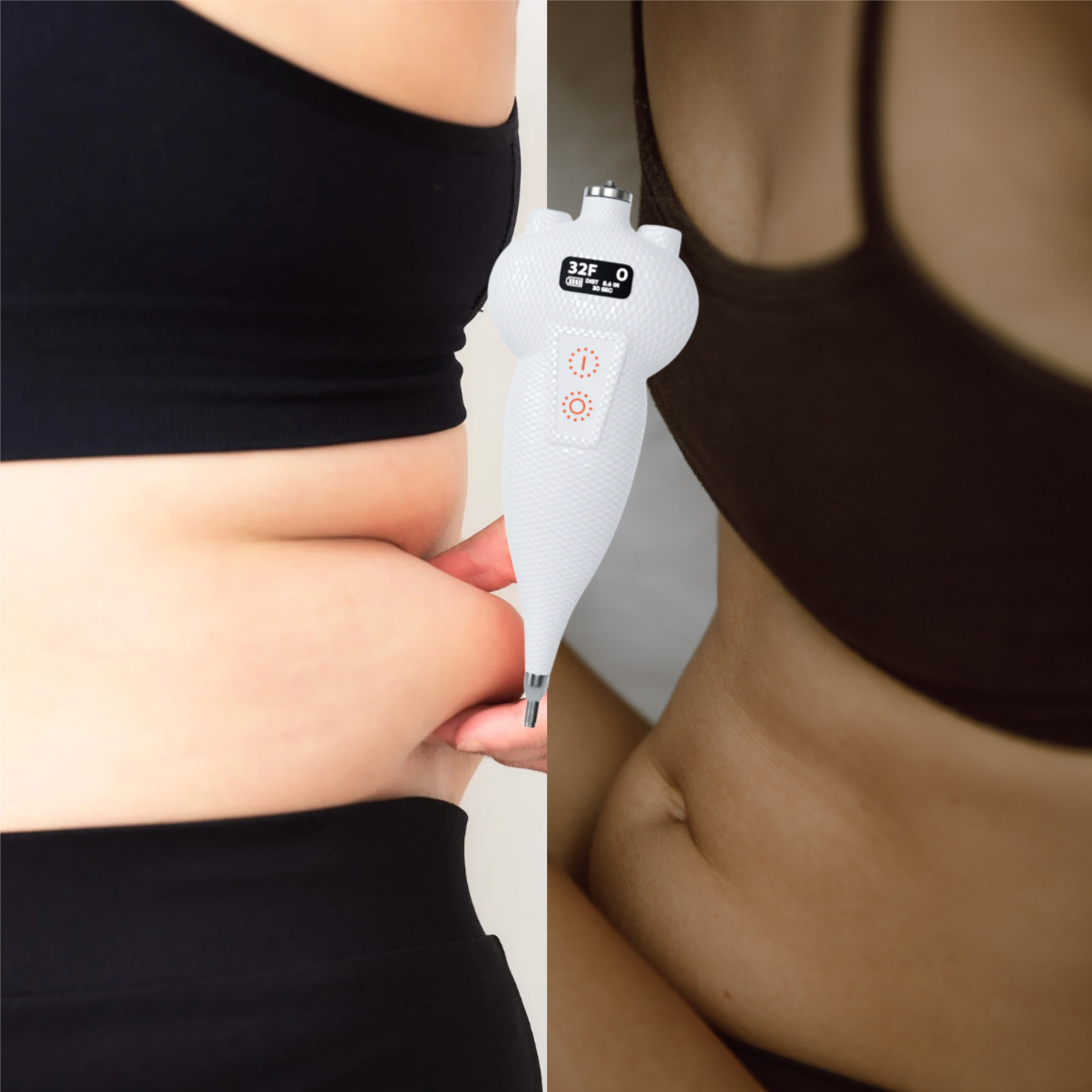 Targeted Cryotherapy (Abs/Flanks) at Ultimate Solutions Medical Spa in Stamford, CT
