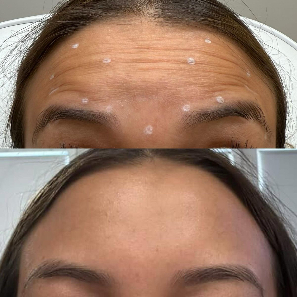 💉Neuromodulator Treatment at Zoraya Velez AESTHETICIAN in Richmond, VA