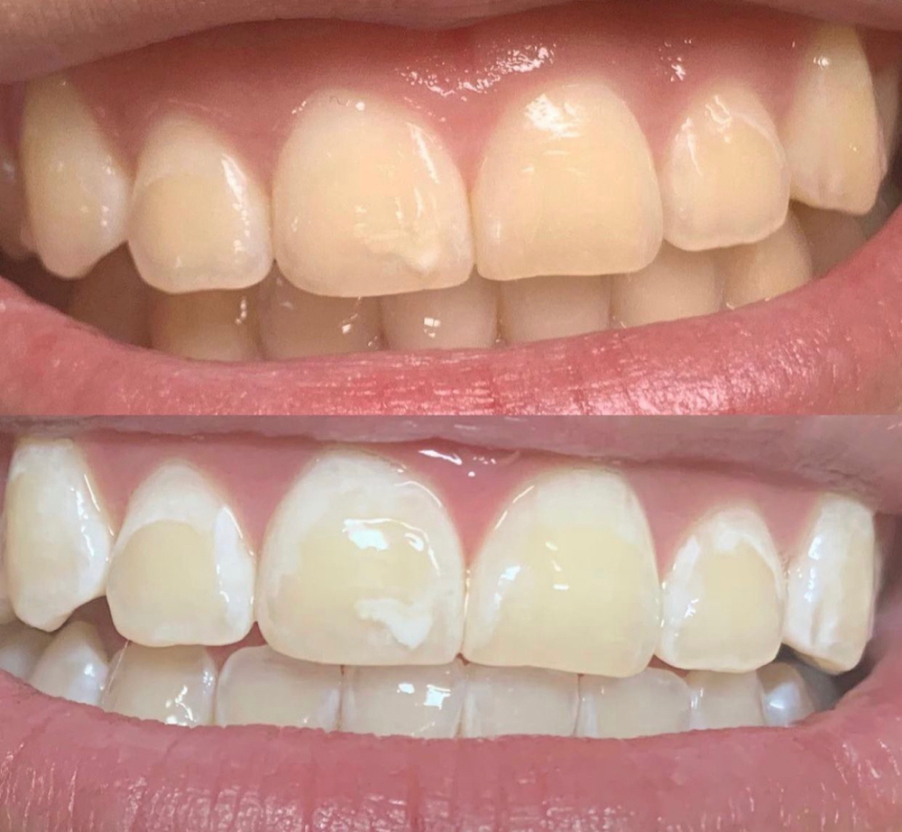 60 Min Teeth Whitening Session