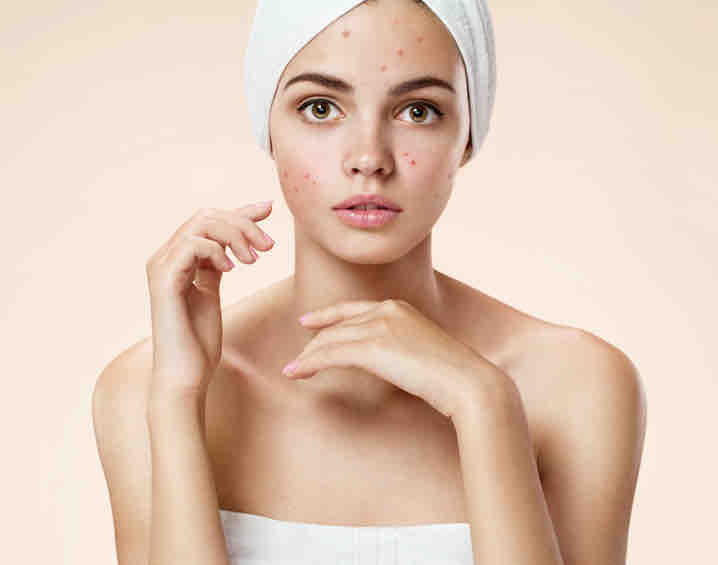 Acne Facial or Therapy 1hr