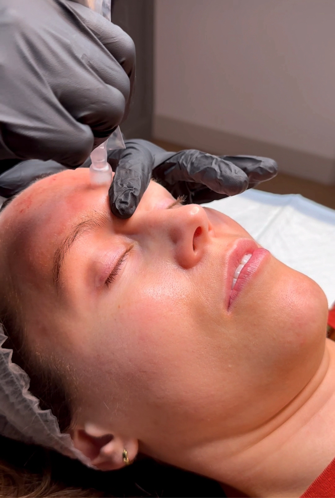 Microneedling