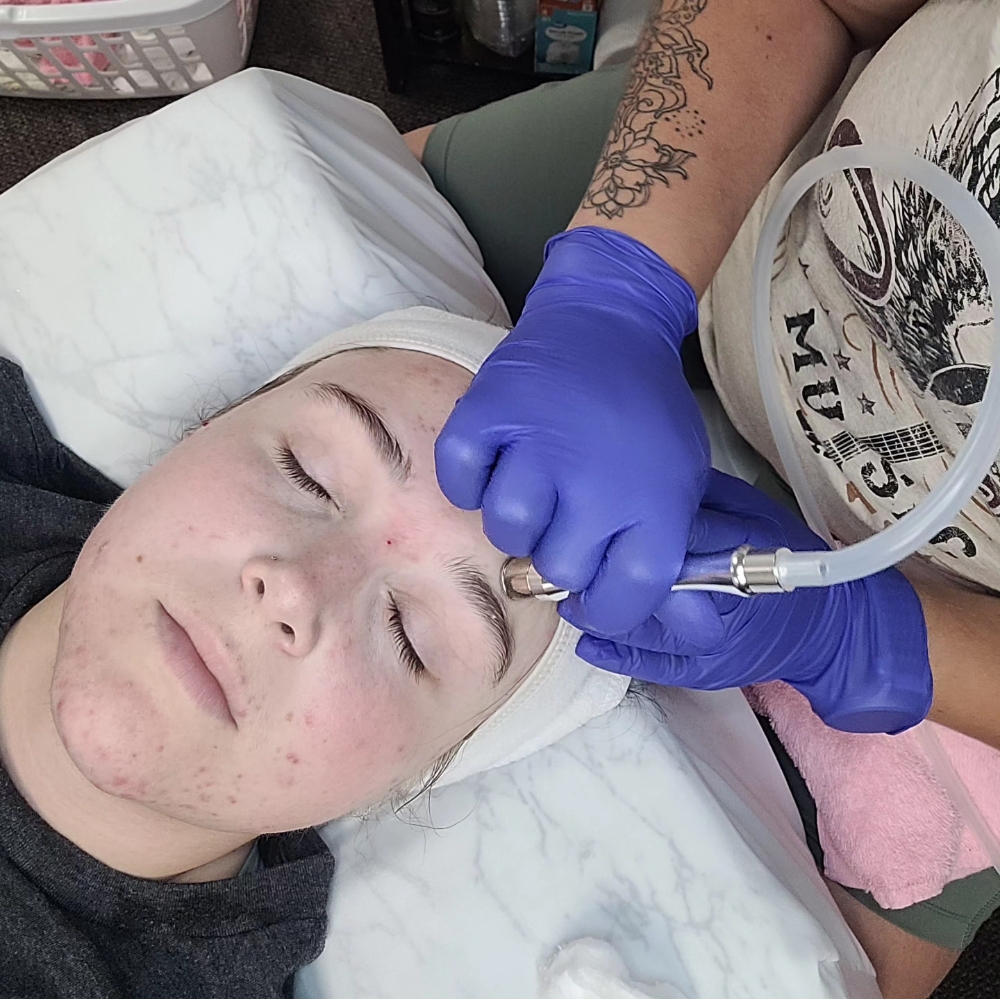 Microdermbrasion Facial