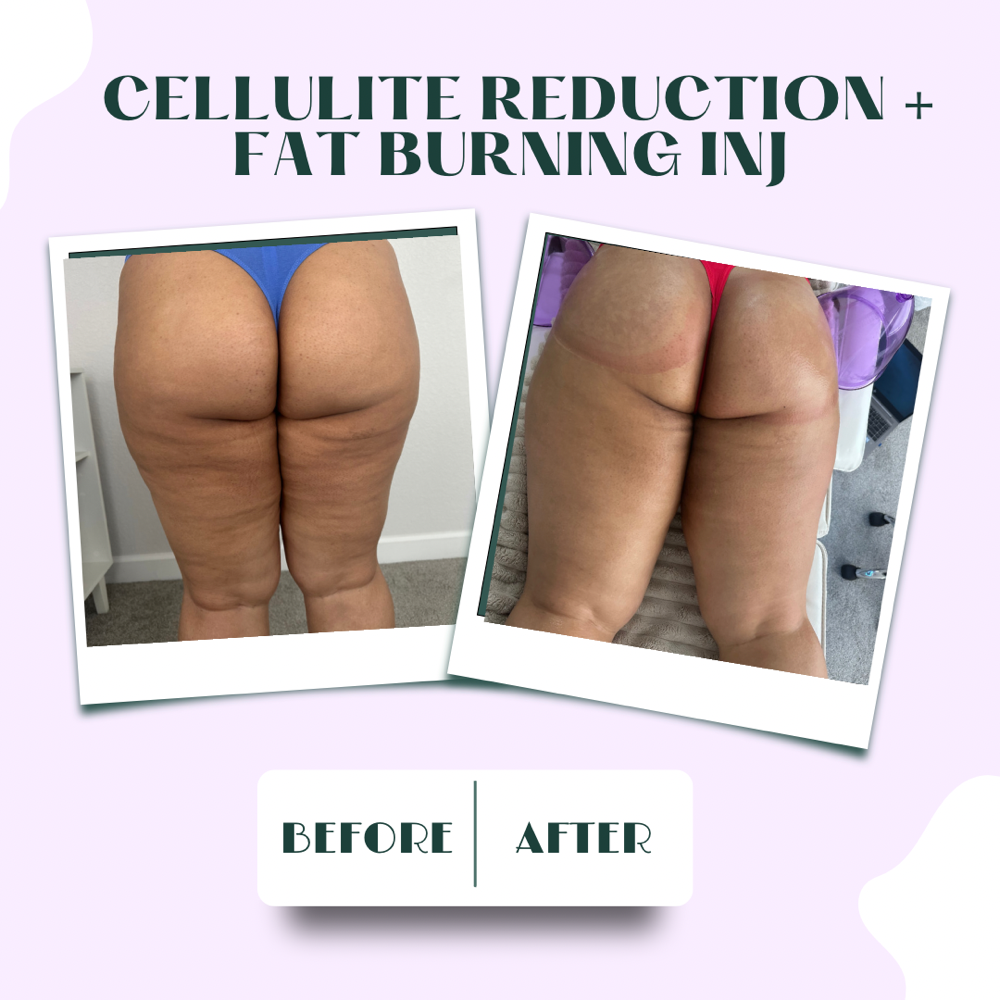 Cellulite Treatment