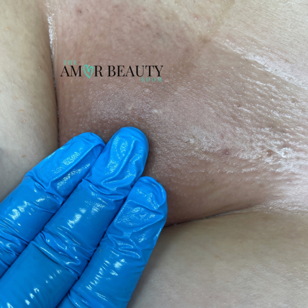 Bare Brazilian at The Amor Beauty Room in Fort Worth, TX