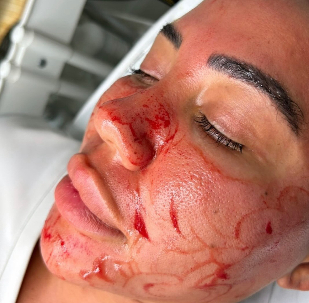 Microneedling Facial at The Twisted Angel Salon & Spa in Bloomington, IN