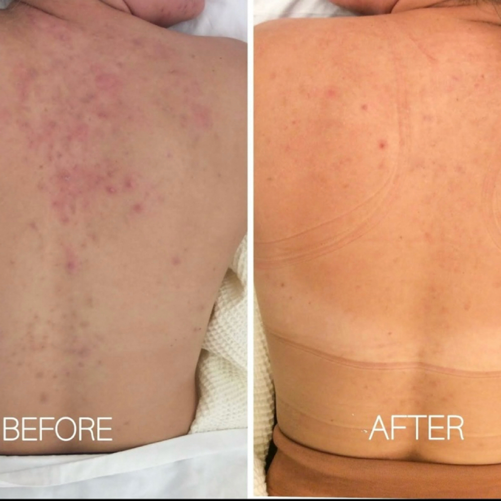 Back Facial at Glow Beauty Lounge in New Concord, OH