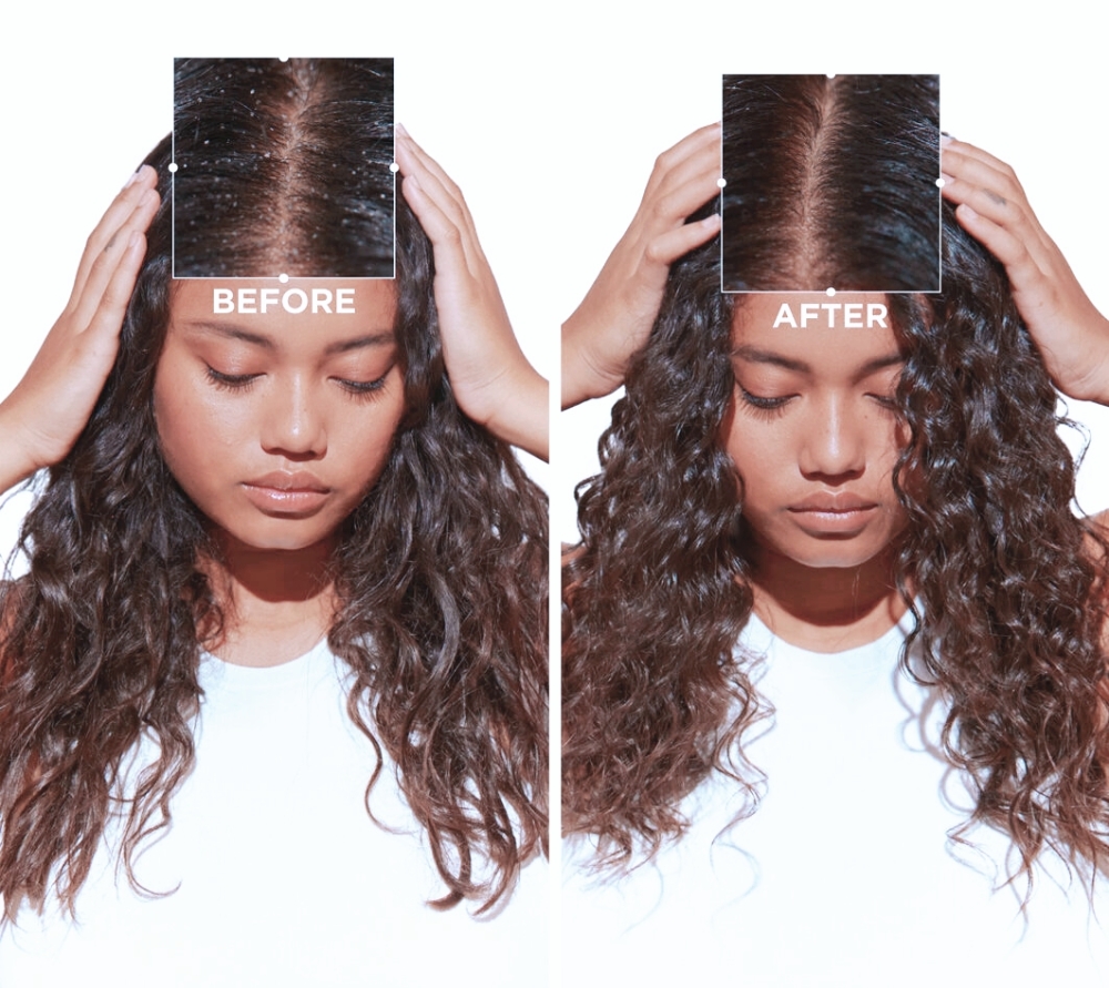 Scalp Exfoliation