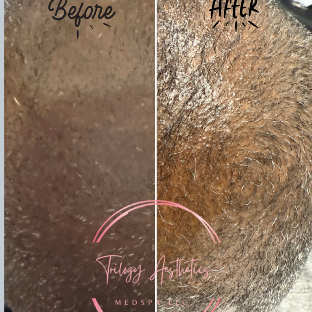 Hair Restoration Consultation at Trilogy Aesthetics Medspa & Wellness in Atlanta, GA