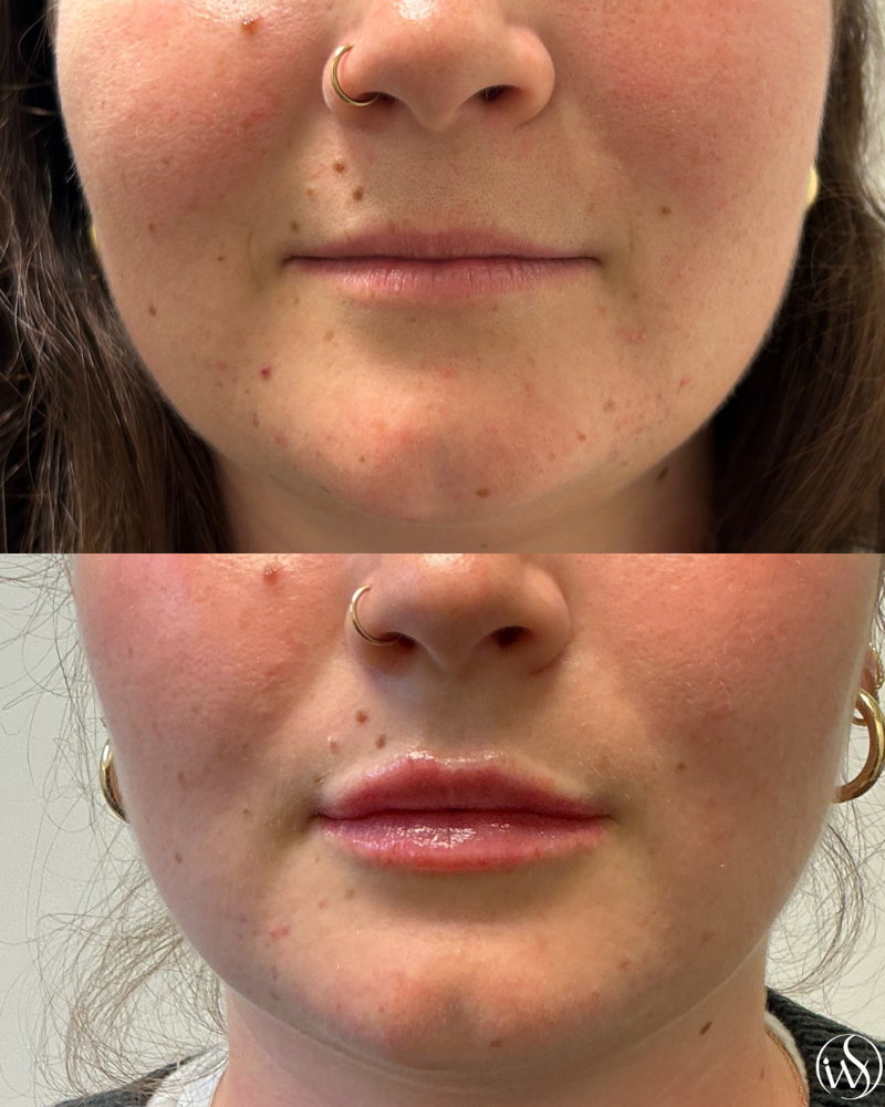 Lip Flip at IWS Aesthetics, PLLC in Detroit, MI