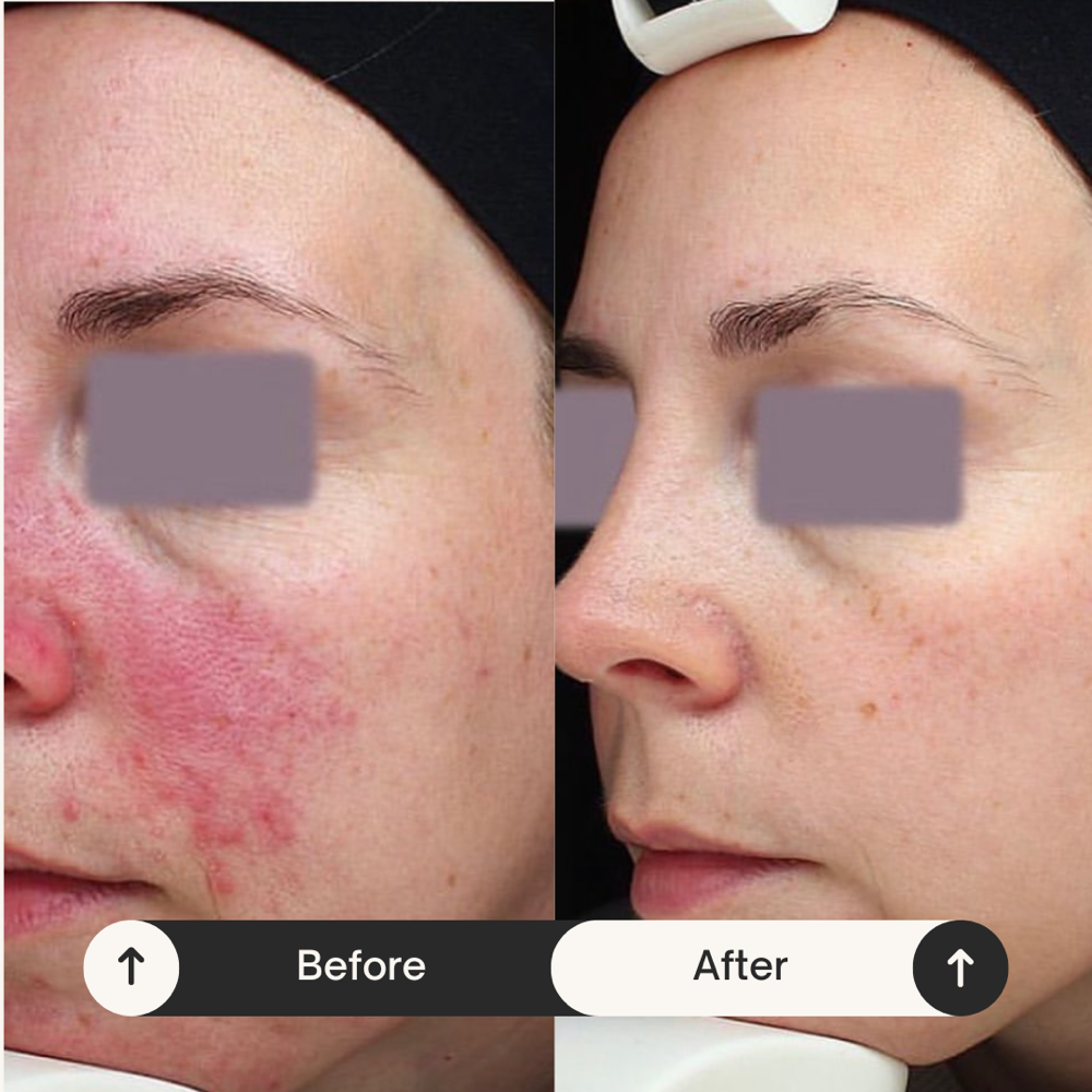 Rosacea (Face)