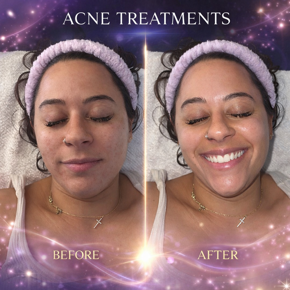 Acne Rituals at MJ Celestial Beauty and Wellness in Saint Petersburg, FL