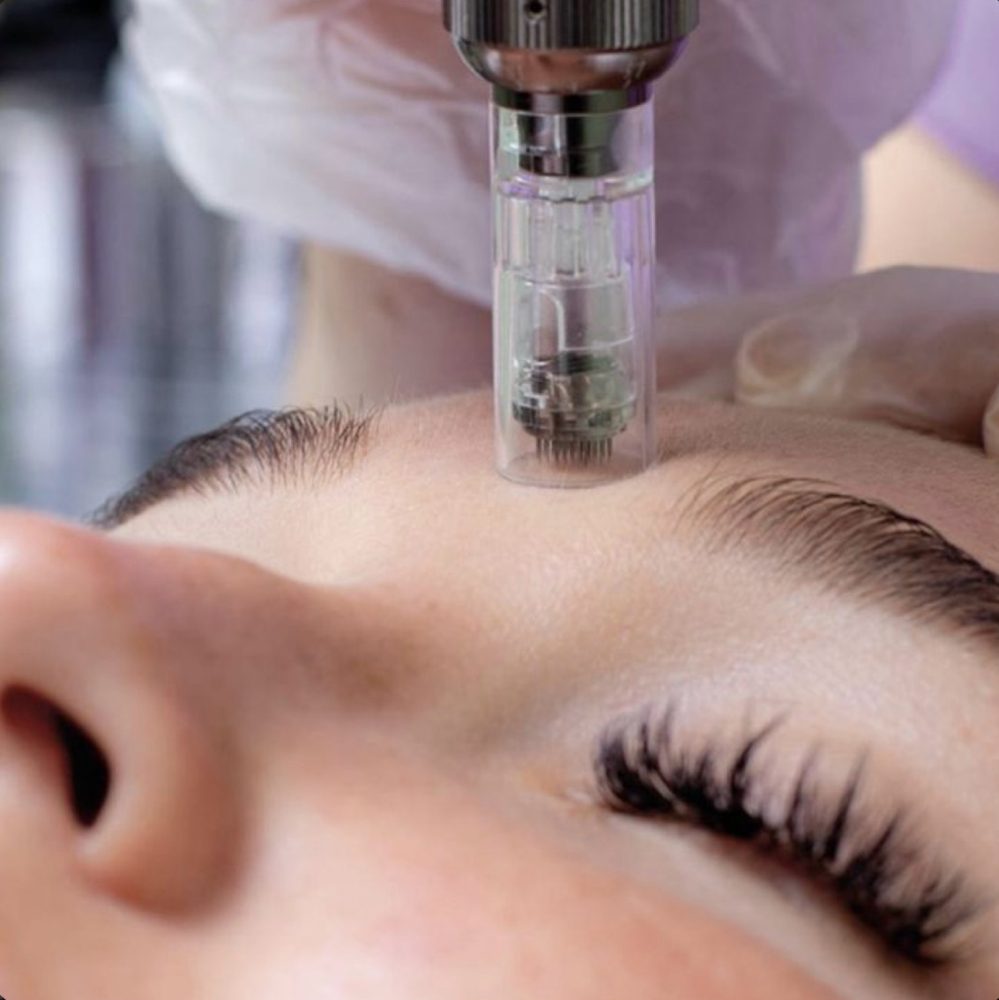 Microneedling