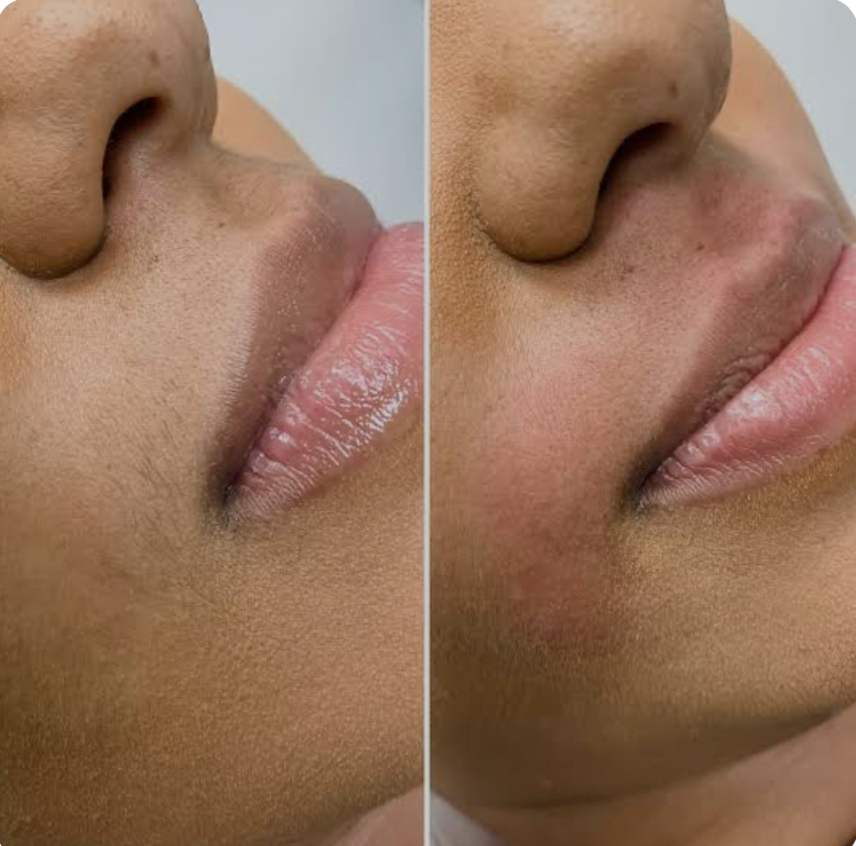 Bare Kiss (Upper Lip Wax)