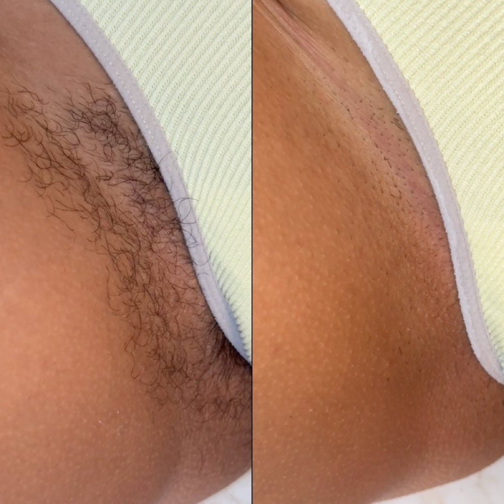 Bikini Line at Belladz Wax Studio in Beltsville, MD