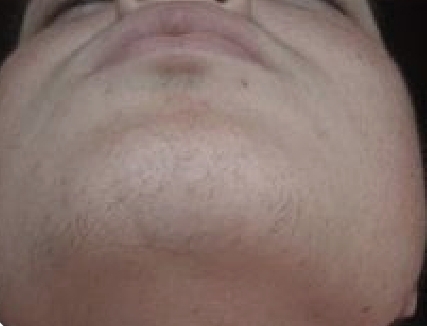 Chin Wax