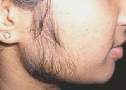 Sides (sideburns)
