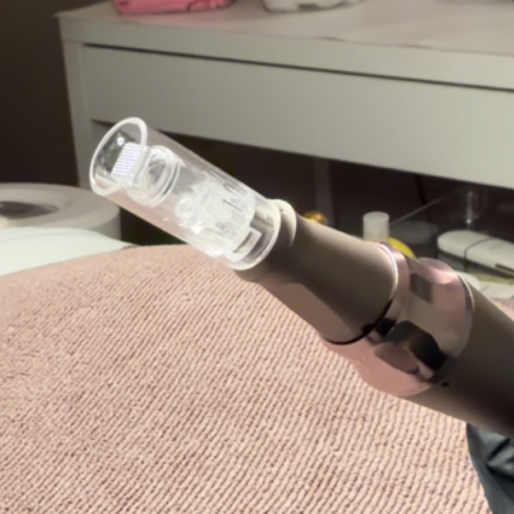 Nano Pen Add On at The Dermal Clinic in Lodi, CA