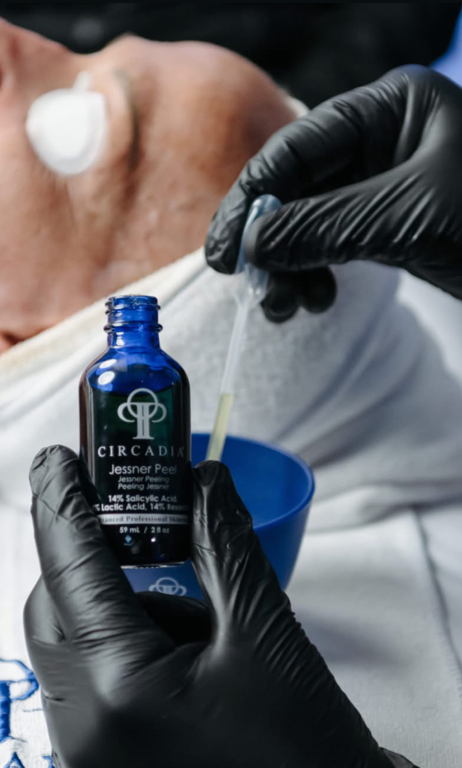 Chemical Peel
