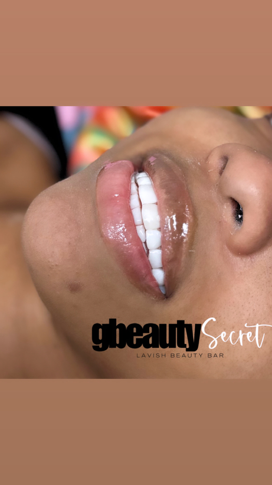 Composite Veneers 8x8