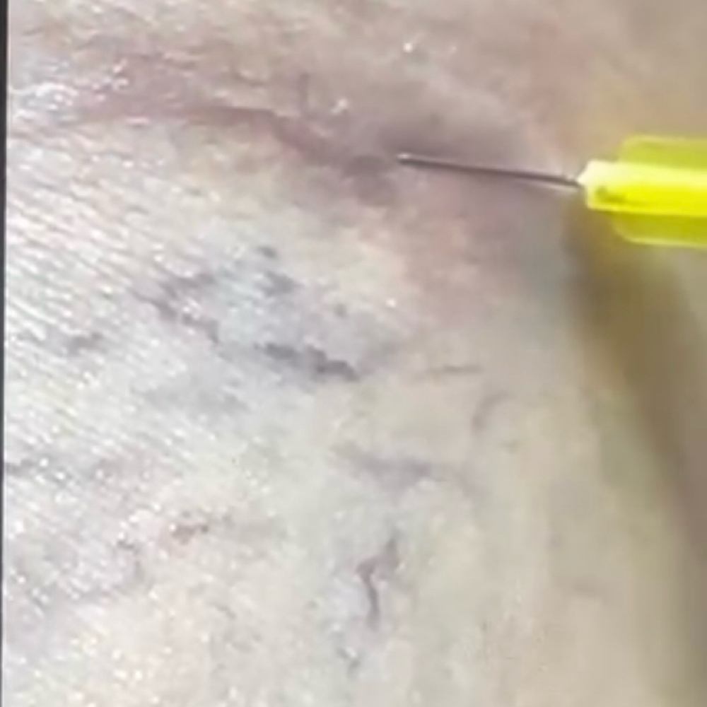 Cosmetic Sclerotherapy at T&N Skin Med Spa Inc in Abington, PA