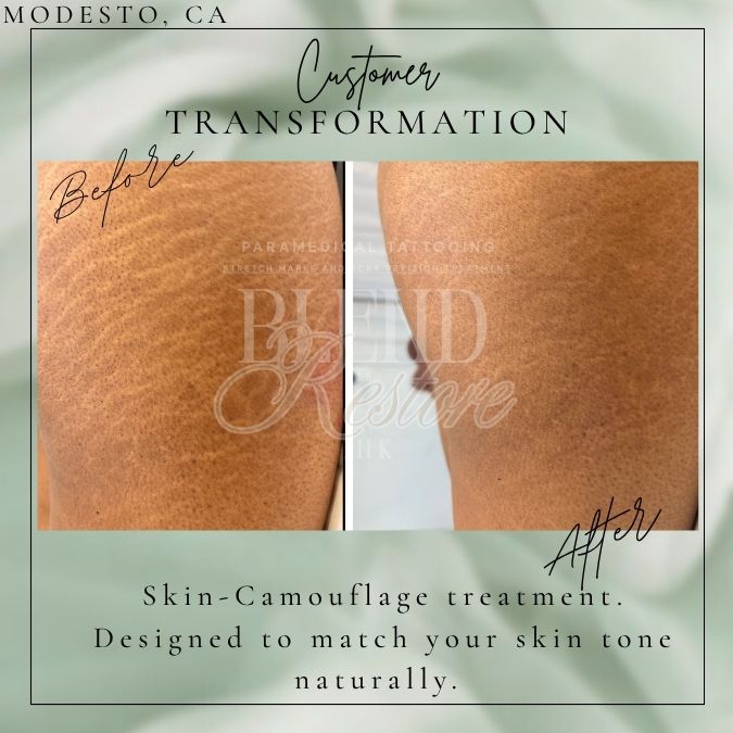 2 area Package Stretch Marks