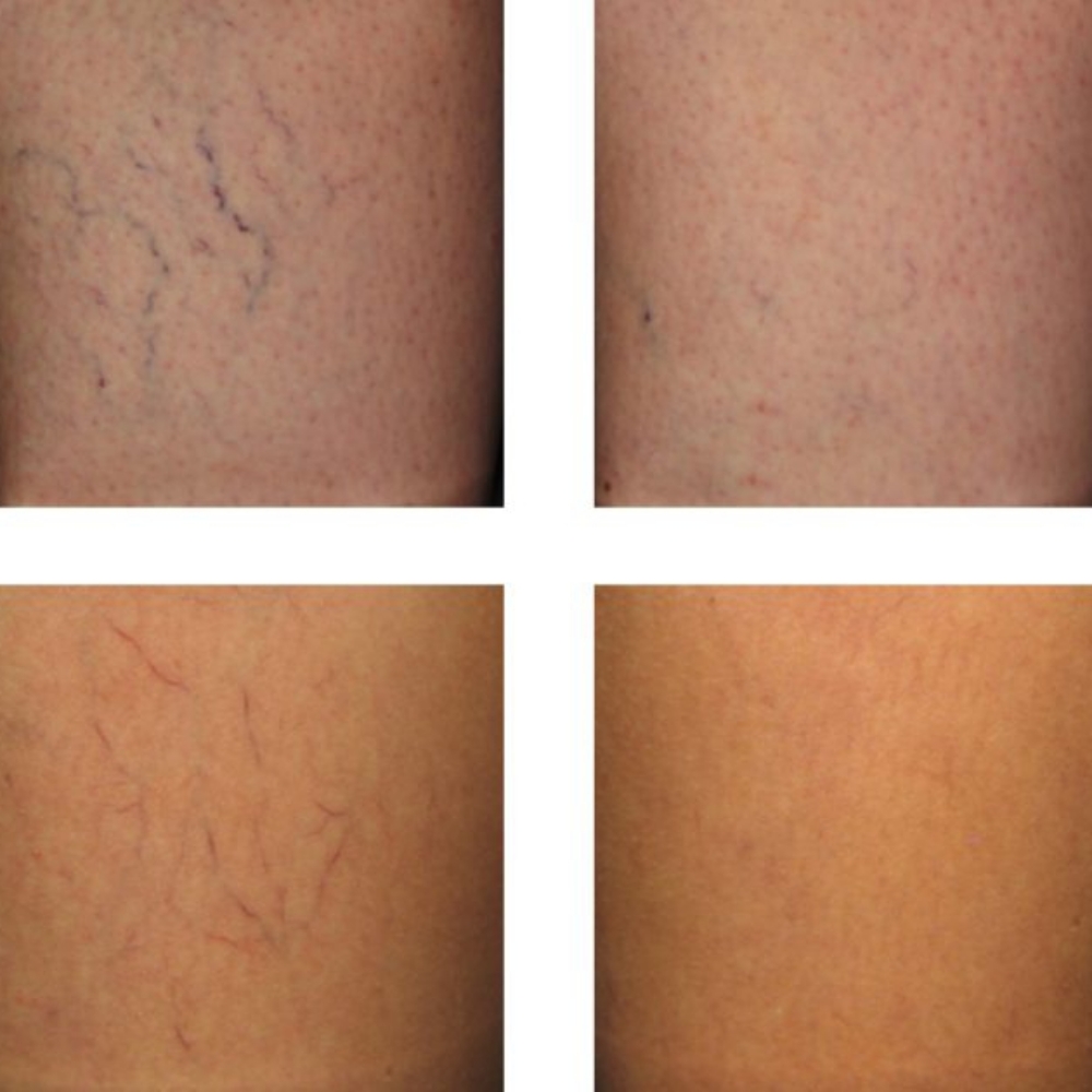 Sclerotherapy For Spider Veins at Glass Face Aesthetics LLC in Fort Stockton, TX