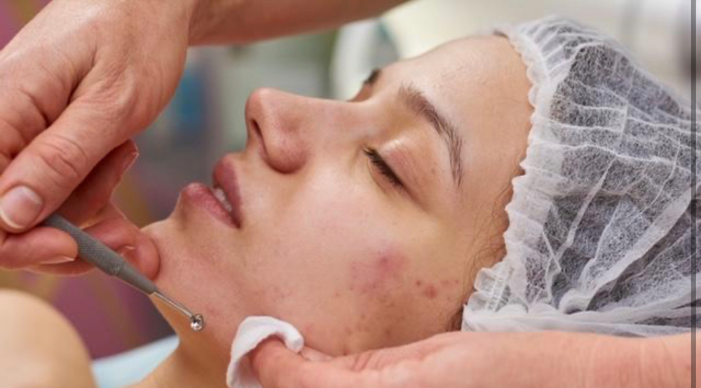 Acne Facial W/Microderm/Extractions