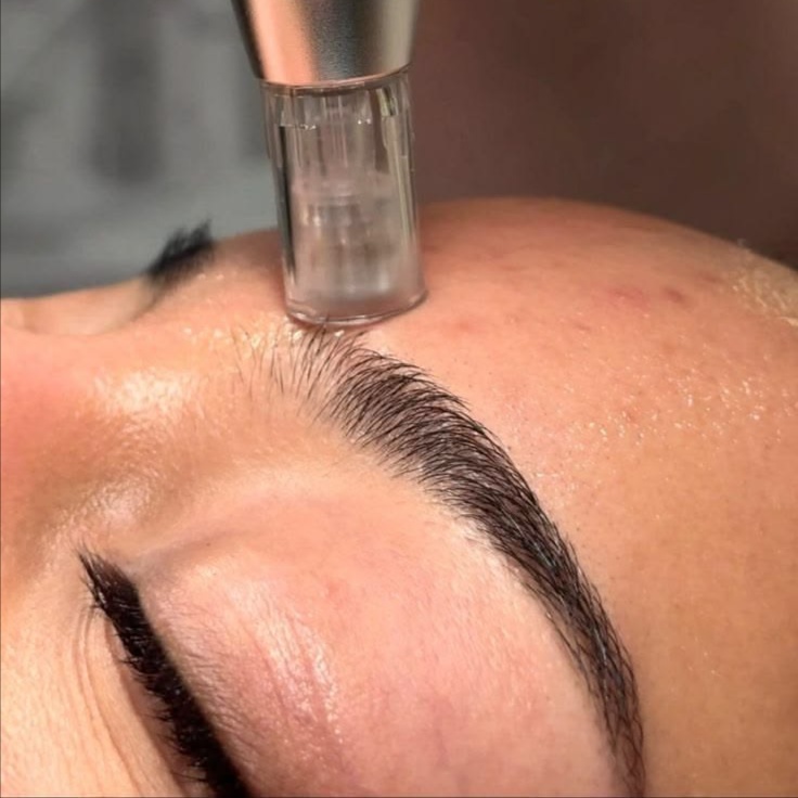 Nano needling at lillyrosebeauty in Murrieta, CA