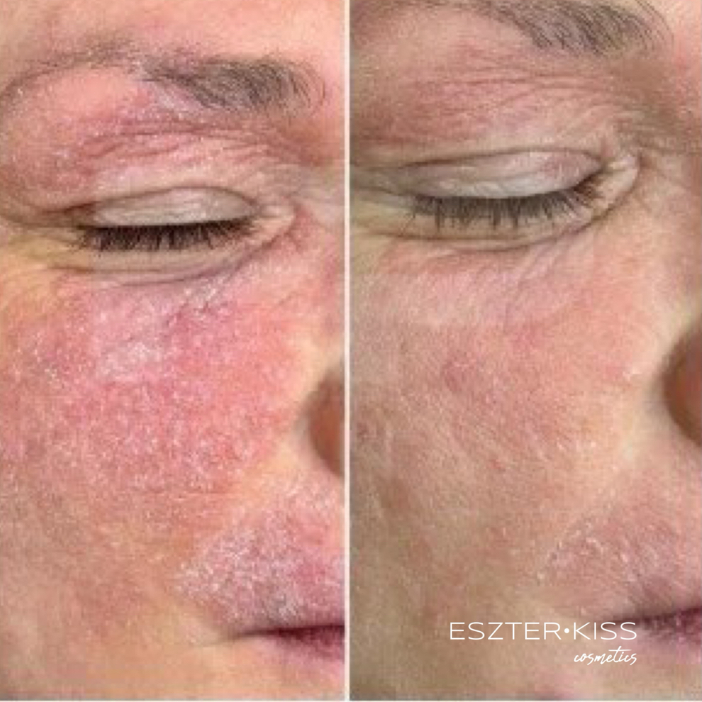 Eczema Treatment-Plasma Fusion at Eszter Kiss Cosmetics in Deltona, FL