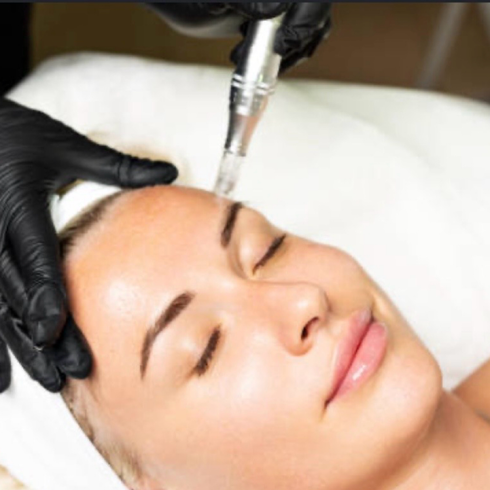 Microneedling at Forever Young Esthetics in Windsor, CO