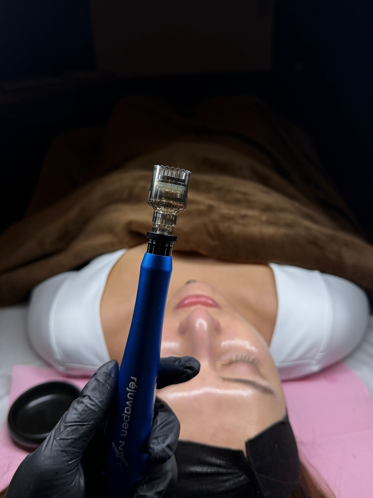 Microneedling Consultation