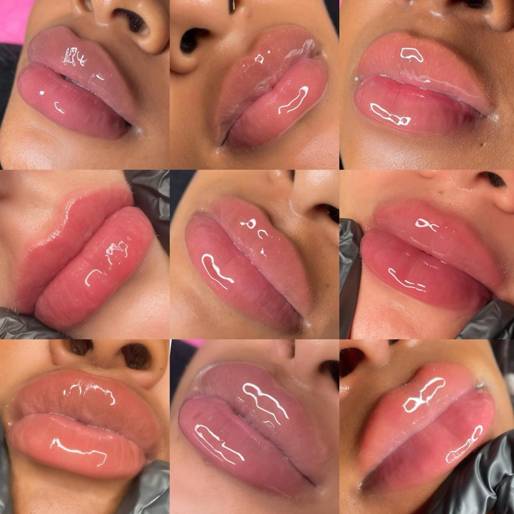 1ML - LIP FILLER (NEEDLELESS)