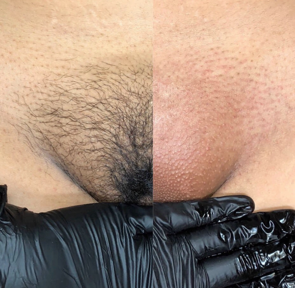 Brazilian Wax + Underam Wax