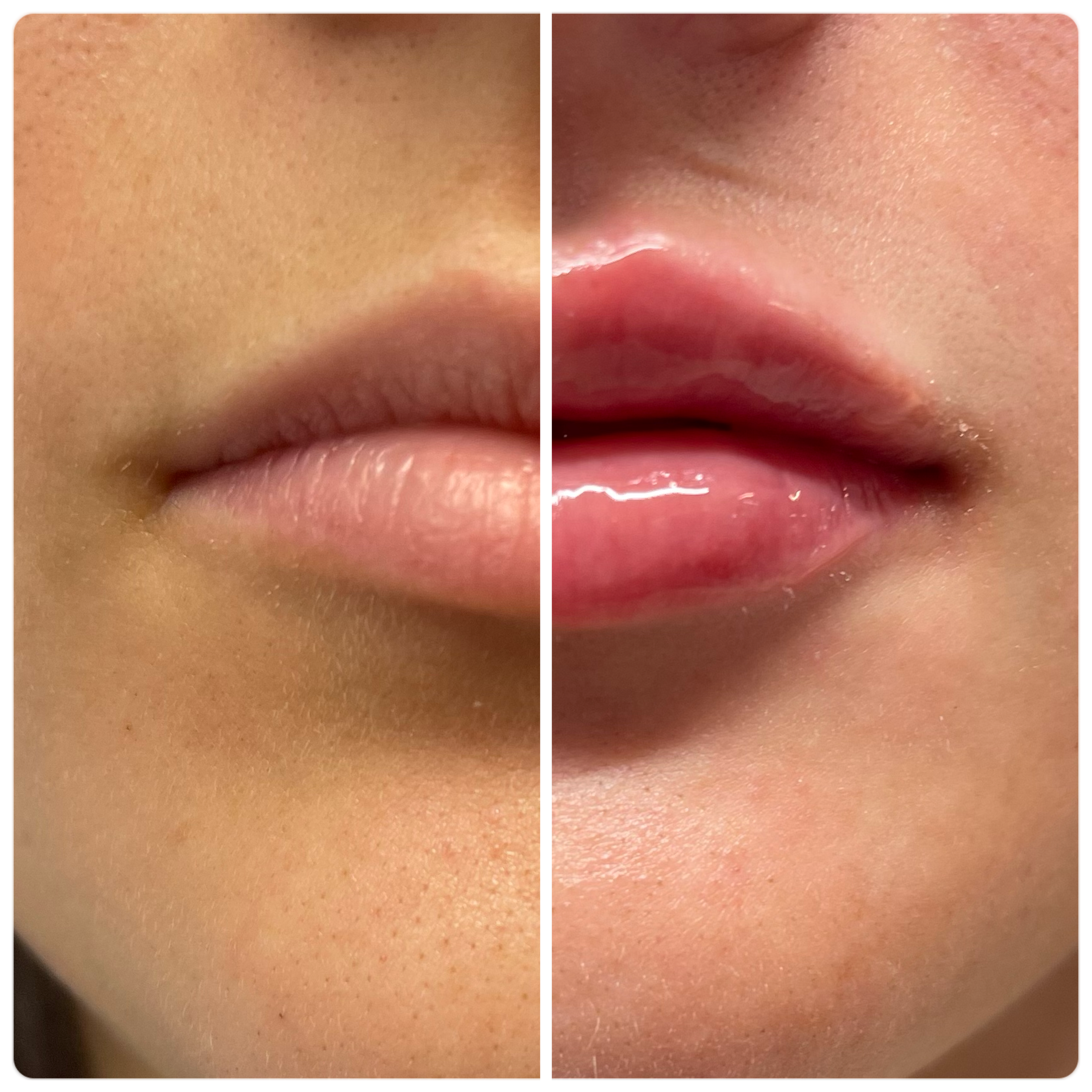 Lip Filler Injection